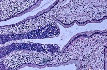 ►子宫颈上皮瘤的病理组织学图像（苏木精-伊红染色）。来源：Wiki
