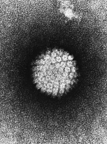 ►电子显微镜下的Human papillomavirus（HPV）。来源：Wiki