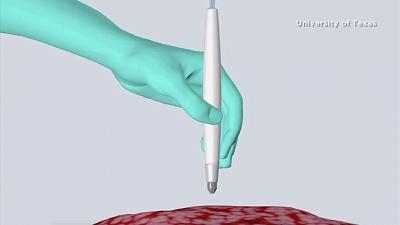 美国大学发明可检测癌症的笔