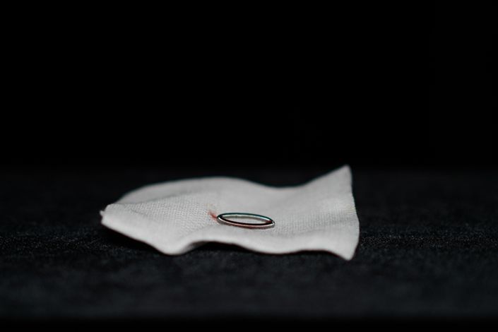 An IUD, a widely used contraceptive device in China, that has just been removed from the body. Photo: Cai Yingli/Caixin